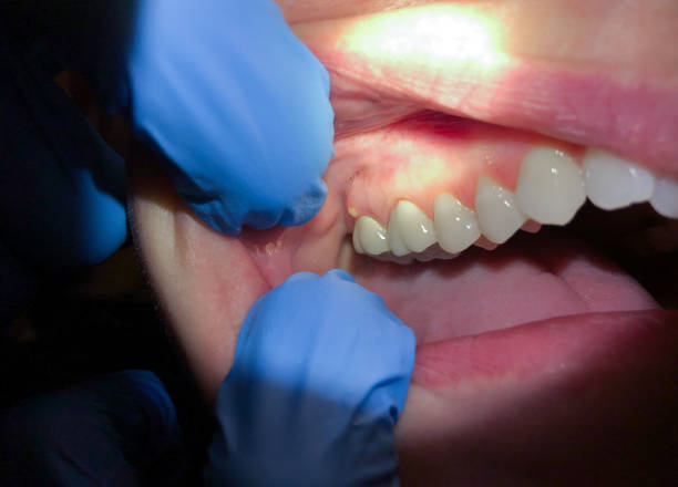 Best Dental Abscess Treatment in Prosper, TX